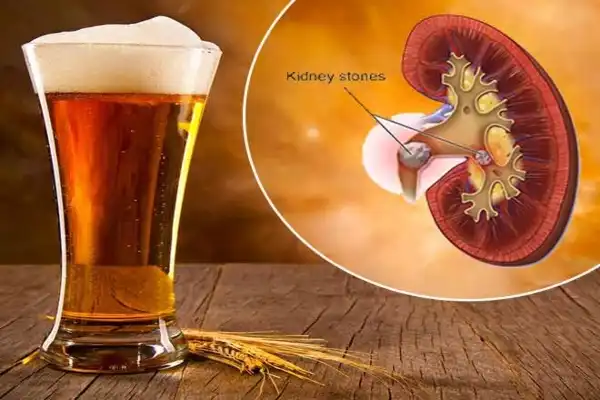 Beer is good for kidney stones
